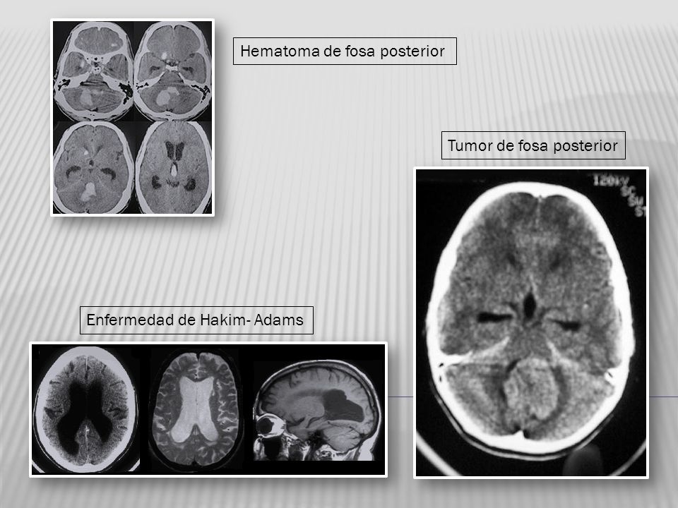 enfermedad de hakim adams